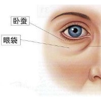 填充泪沟失败修复术