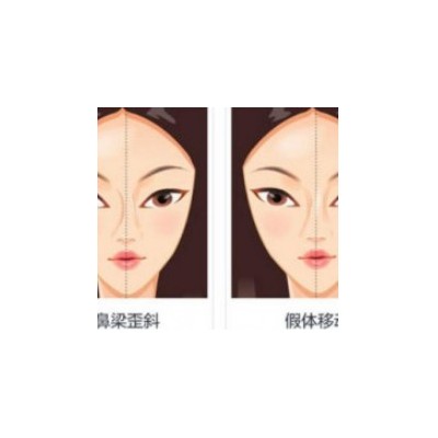 鼻部假体修复