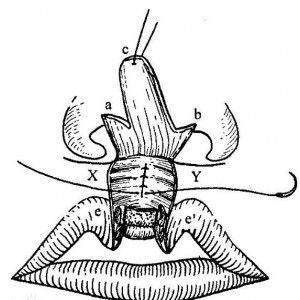 鼻中隔软骨延长鼻小柱