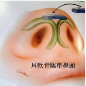 耳软骨垫鼻尖