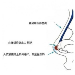 自体筋膜垫鼻尖