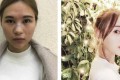 鼻部手术手术果怎么样，恢复果对比图