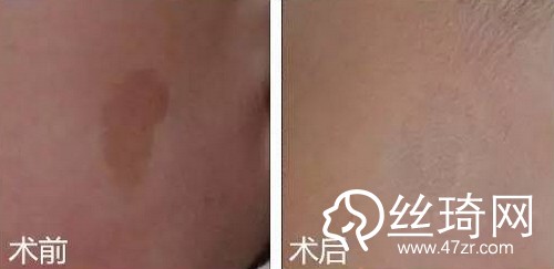 【激光祛斑案例对比图】