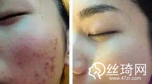 【祛痘案例对比图】