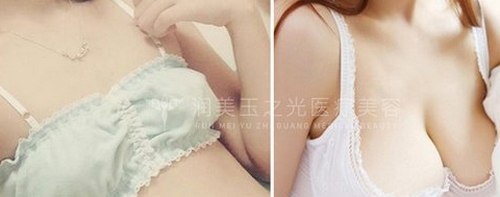 北京润美玉之光自体脂肪丰胸哪个医生好