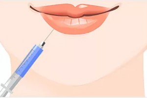 玻尿酸丰唇整形手术注意事项 注射玻尿酸会肿吗