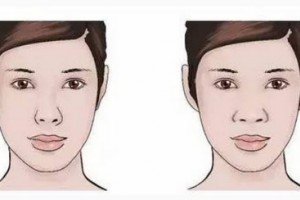 艾尚美整形隆鼻：塌鼻子如何变成翘鼻子 什么是精细鼻部手术整形
