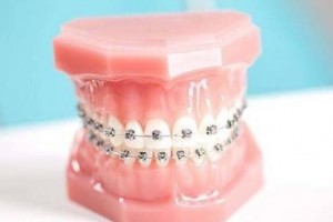 做牙齿矫正有哪些注意事项？