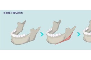 下颔角整形手术要多少钱？下颌角手术后护理注意事项?