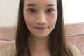 膨体做鼻梁果怎么样，恢复果对比图