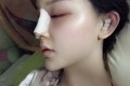 鼻子塌短平通过鼻部手术整形后一个月案例分享与果对比图