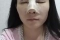 硅胶隆鼻整形果好不好及案例展示