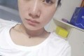 自体脂肪丰面颊案例分享与果对比图