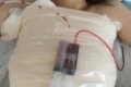 自体脂肪隆胸价格多少钱及自体脂肪隆胸案例展示