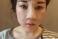 隆鼻果怎么样，恢复果对比图