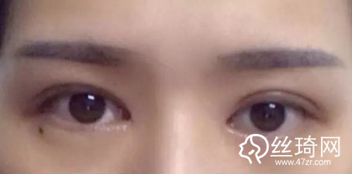 深圳艺星整形医生朱辉：为什么你割的双眼皮会显得“假”？