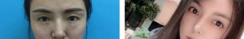 上海宏康医院切开双眼皮有用吗，附反馈图