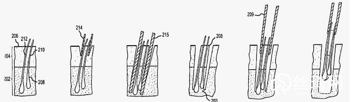 合肥维多利亚植发过程演示