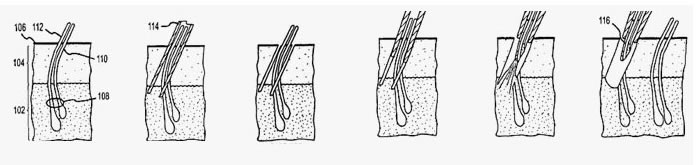 普通植发过程演示