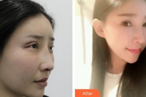 广州广美整形美容医院伍新鹏整形价格表附双眼皮修复案例展示
