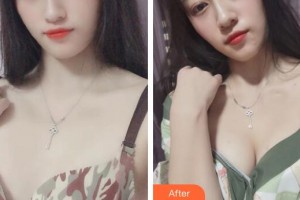 广州美莱医疗美容医院熊明根整形价格表附浓缩丰胸案例展示