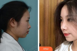 广州华美医疗美容医院沈绍勇整形价格表附鼻部手术案例展示