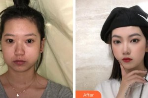 广州华美医疗美容医院李春满整形价格表附下颌角磨骨案例展示