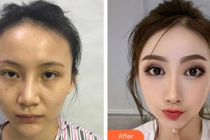 广州军区总医院全军激光整形美容中心彭丽霞整形价格表附鼻部手术整形案例展示