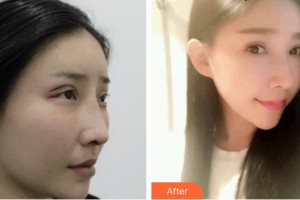上海美之仁医疗美容医院邢婧整形价格表附双眼皮修复案例展示