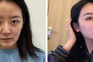 南京亚韩医学美容医院刘丹整形价格表附肋软骨隆鼻案例展示