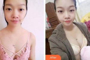 上海保加医疗美容门诊部Tony整形价格表附浓缩脂肪丰胸案例展示