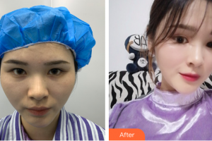 广州现代医院数字化整形美容中心刘怡整形价格表附鼻部手术案例展示