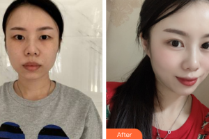 广州中科美整形医院张金明整形价格表附眼部综合案例展示