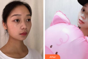 广州康华清医学美容门诊部潘立清整形价格表附水氧活肤案例展示