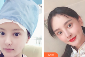 广州慕美医疗美容医院成红整形价格表附发际线种植案例展示
