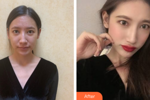 广州愈生医院美容整形中心李寅整形价格表附肋软骨隆鼻案例展示