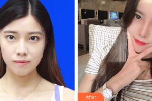 上海诺诗雅医疗美容医院陈达整形价格表附肋软骨隆鼻案例展示