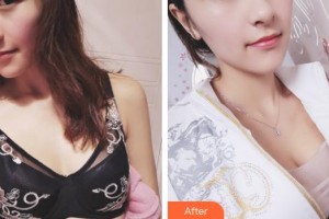 上海明慨医疗美容门诊部慎全祥整形价格表附浓缩丰胸真实案例案例展示