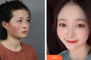 广州远东美容医院冯洁整形价格表附微针修复敏感肌案例展示