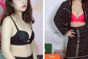 上海明慨医疗美容门诊部王亮整形价格表附浓缩丰胸真实案例展示