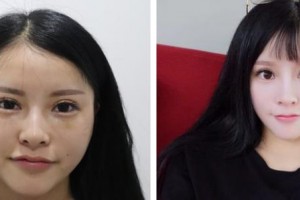 上海达医院医疗美容科齐金杰整形价格表附鼻部手术案例展示