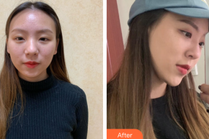广州星团医学美容门诊部田夫整形价格表附自体肋软骨隆鼻案例展示