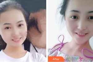 上海华美医疗美容医院黄嵩整形价格表附半隐形单晶案例展示