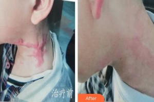 上海瑞金医院舟山分院烧伤整形美容科黄晓琴整形价格表附烫伤疤痕修复案例展示
