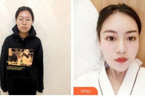 上海爱尔丽医疗美容门诊部吴瑞星整形价格表附创可贴面部吸脂瘦脸案例展示