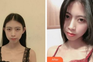 上海爱尔丽医疗美容门诊部苏愉婕整形价格表附微针美白嫩肤缩小毛孔案例展示