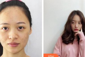 上海天美医疗美容医院秦易见整形价格表附面部吸脂瘦脸案例展示