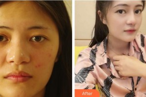 上海天美医疗美容医院吴三丰整形价格表附自体肋骨隆鼻案例展示