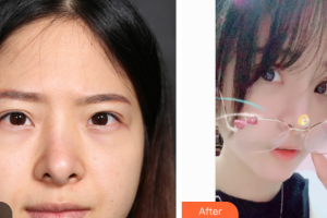 上海微蓝医疗美容门诊部林楠整形价格表附肋骨鼻部手术案例展示