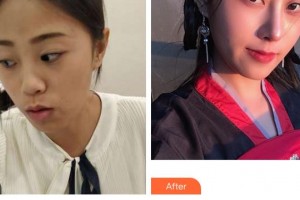 上海悦莱医疗美容门诊部李医生整形价格表附耳软骨隆鼻案例展示